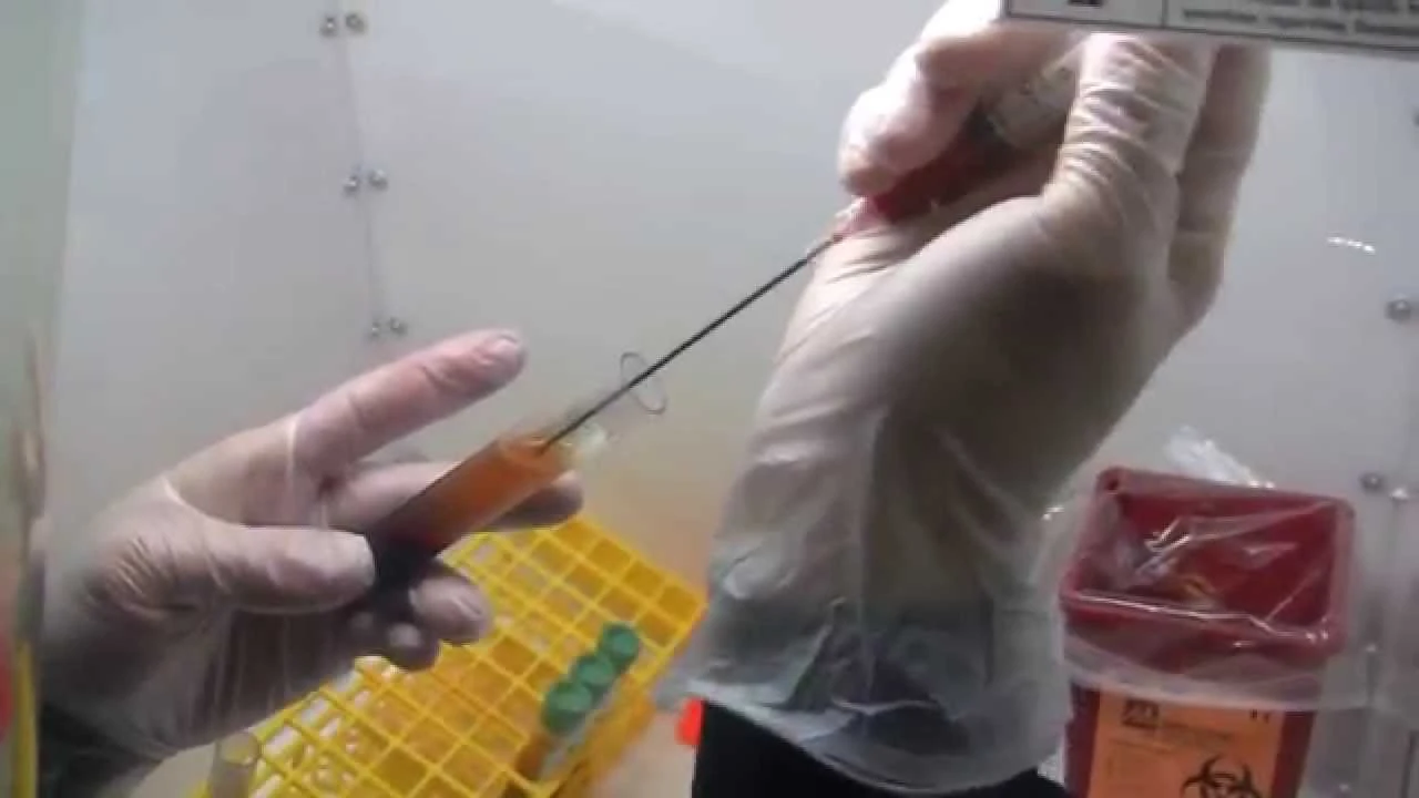 Bone marrow derived stem cells for shoulder pain