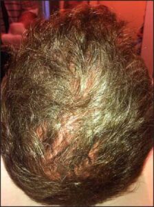 29 Year old man before PRP treatments J Cutan Aesthet Surg. 2014 Oct-Dec; 7(4): 213–219.