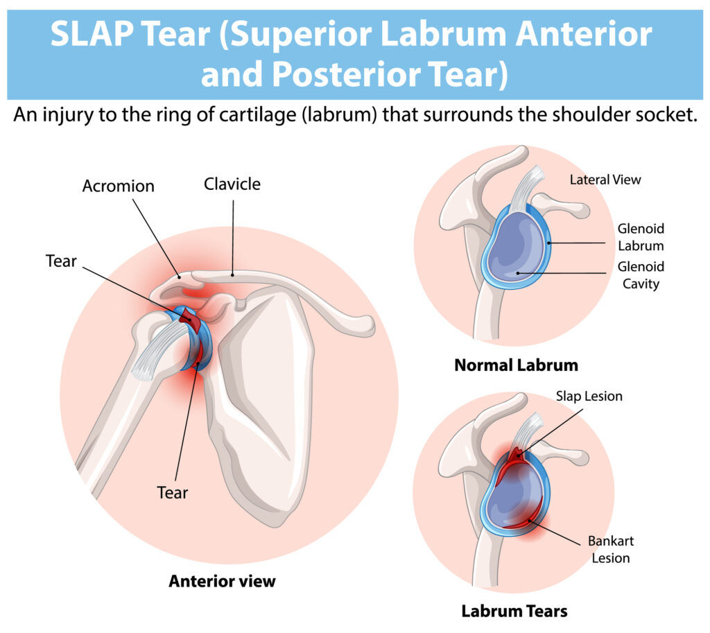 shoulder labrum tears