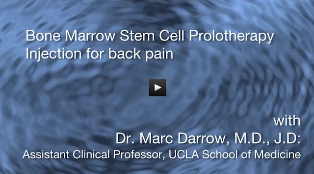 Bone marrow derived stem cells for chronic back pain