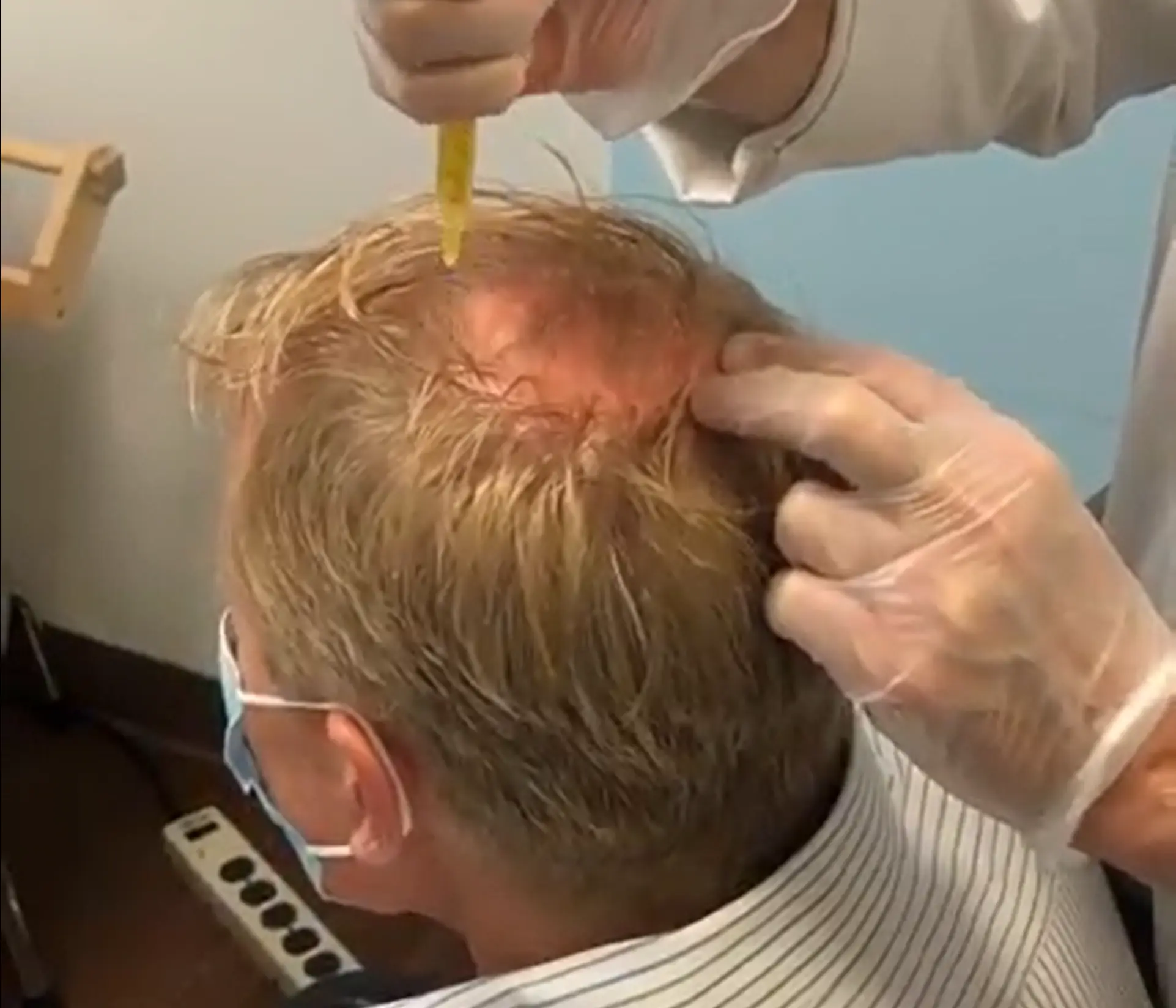 PRP hair injections